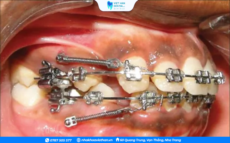 Niềng răng bị đau nhức kéo dài, không có dấu hiệu thuyên giảm nên thăm khám kịp thời