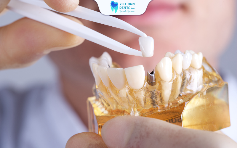 Trồng răng Implant