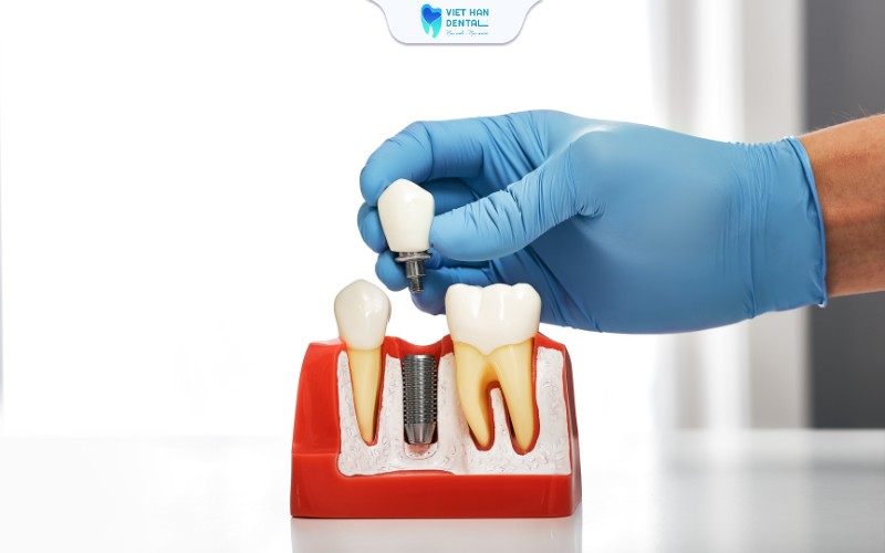 Trồng răng Implant