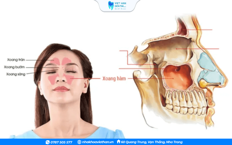 Vị trí xoang hàm