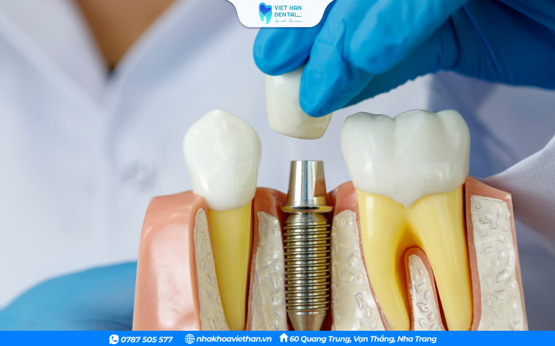 Phương pháp trồng răng Implant
