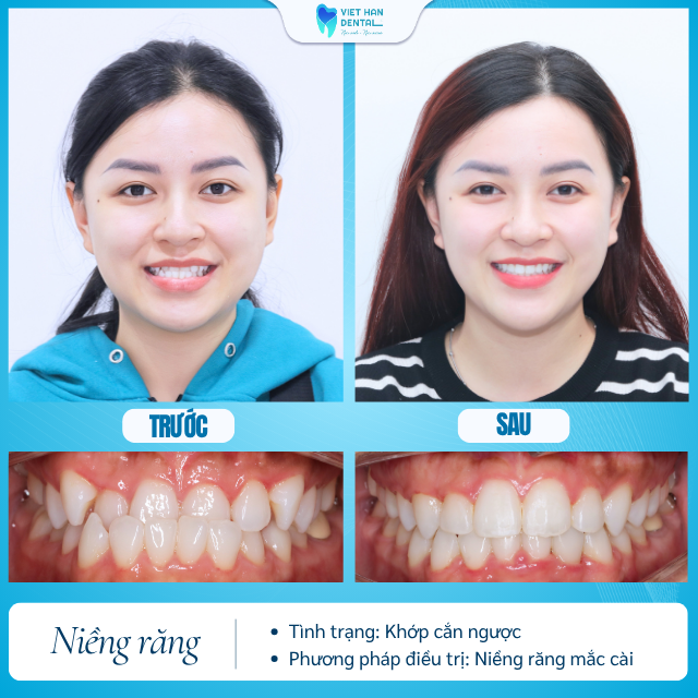 Khách hàng trước và sau khi niềng răng tại Nha khoa Việt Hàn