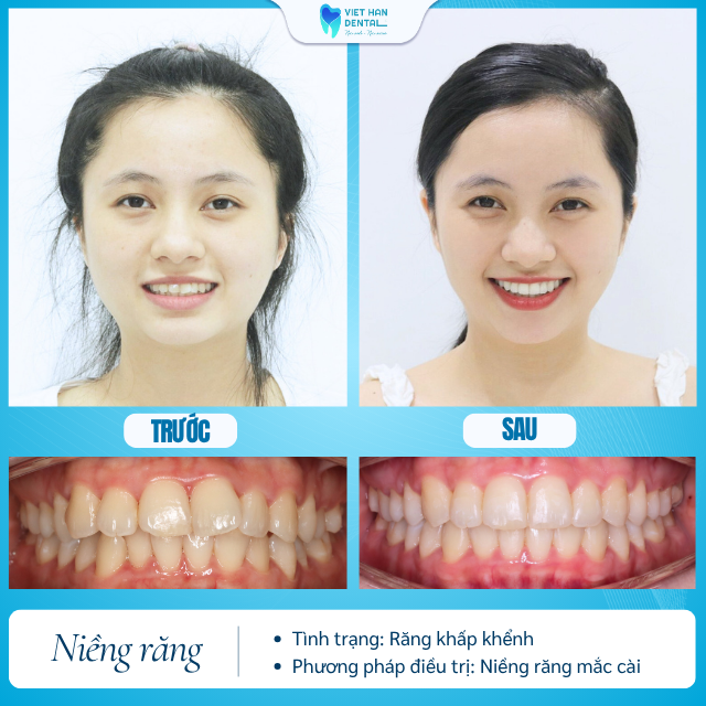 Khách hàng trước và sau khi niềng răng tại Nha khoa Việt Hàn
