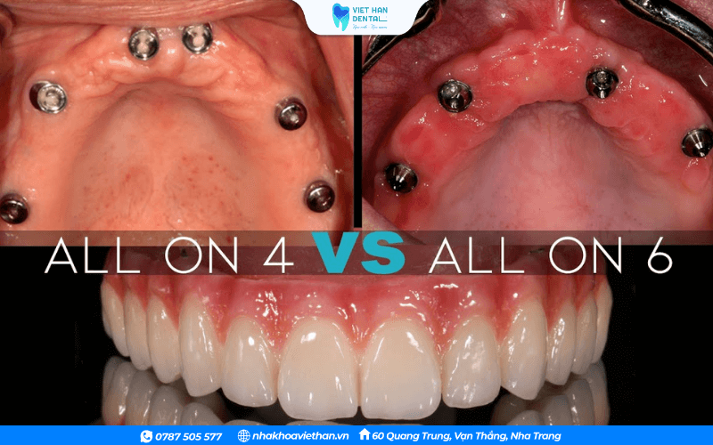 Phương pháp trồng răng All- on 4 và All - on - 6 khác nhau ở số lượng trụ