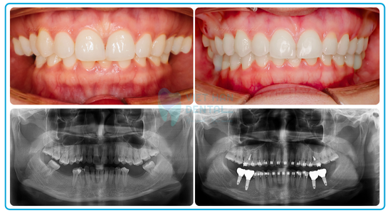 Niềng răng kết hợp trồng Implant