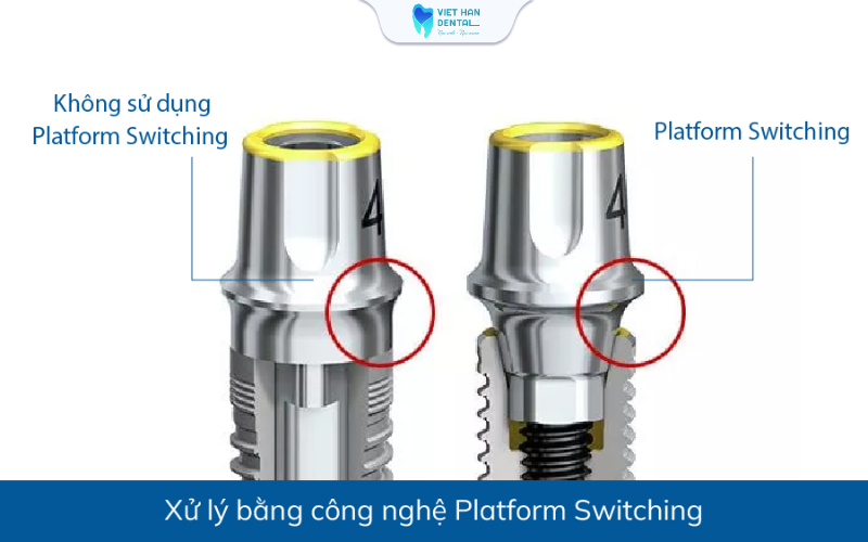 Công nghệ xử lý vùng cổ của trụ implant