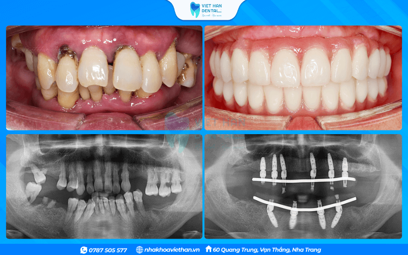 Khách hàng tại Nha khoa Việt Hàn trồng răng toàn hàm All - on -6 hàm trên và All - on - 4 hàm dưới