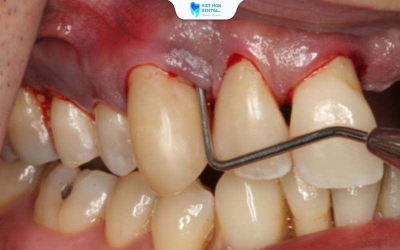 Viêm nha chu sẽ tiến triển âm thầm nhưng nguy hiểm