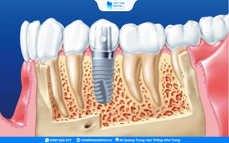 Tình trạng xương đảm bảo tốt mới có thể thực hiện trồng răng Implant