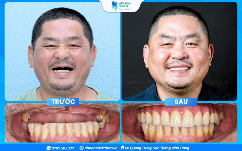Trồng răng Implant có thể sử dụng đến trọn đời nếu chăm sóc đúng cách