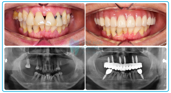 Web RĂng Implant 4 ảnh Ts (1)