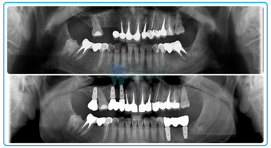 Web RĂng Implant 4 ảnh Ts (1)
