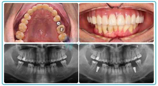 Web RĂng Implant 4 ảnh Ts