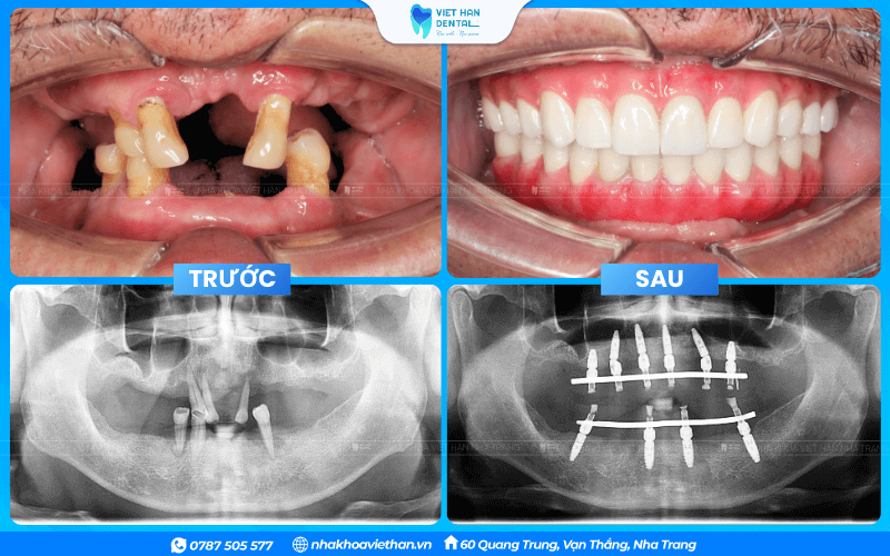 Hàm răng trước và sau khi trồng răng Implant tại Nha khoa Việt Hàn của chú Võ Đức Sử