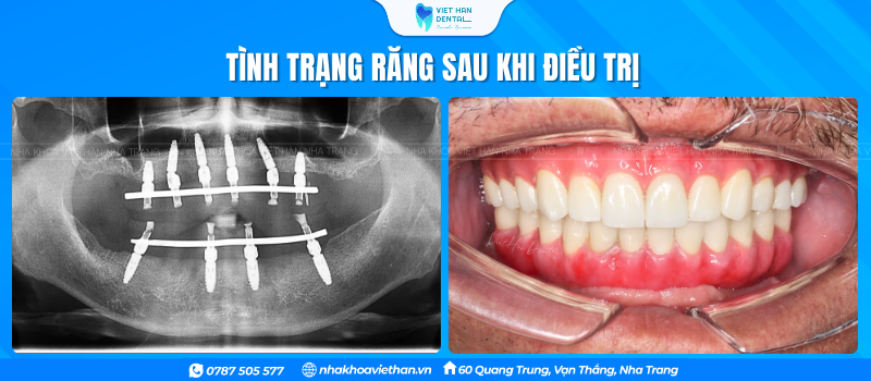 Tình trạng răng của chú Võ Đức Sử sau khi điều trị tại Nha khoa Việt Hàn
