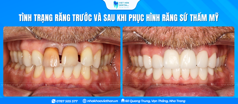 Pham Vu Tình Trạng Răng Trước Khi