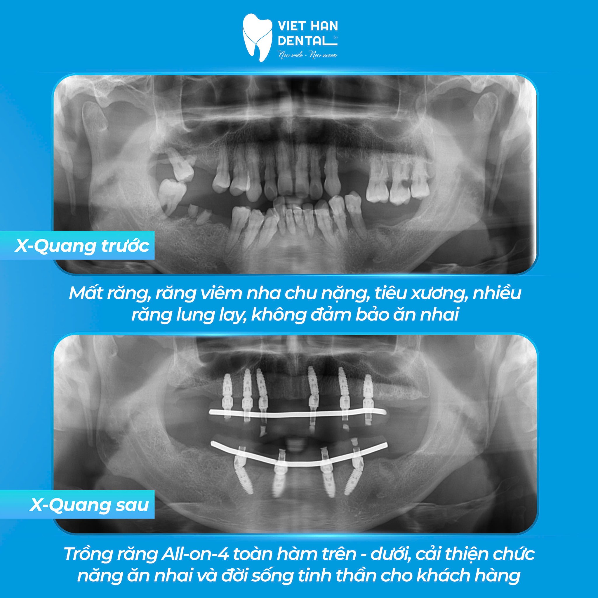 Trước Và Sau Implant
