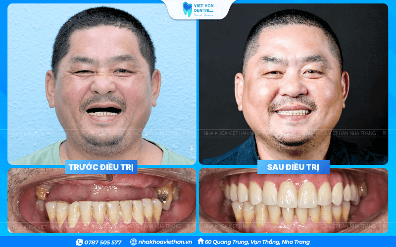 Khách Hàng Bọc Sứ (1)