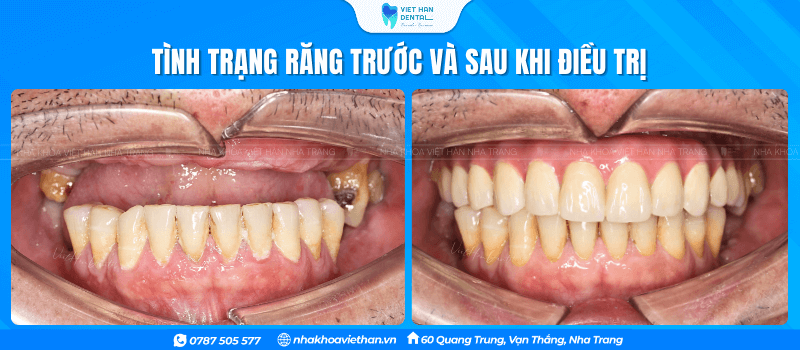 Tình Trạng Răng Trước Khi (1)