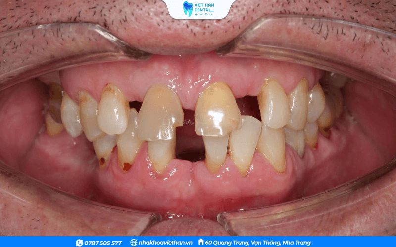 Tình trạng mất nhiều răng