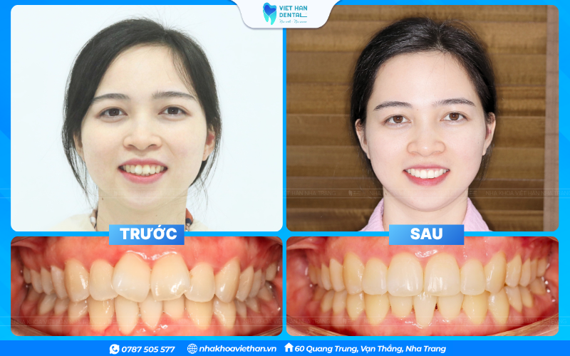 Tình trạng răng cửa mọc không thẳng hàng