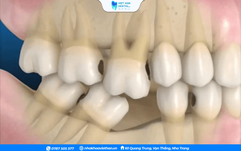 Khi một chiếc răng mất đi, các răng bên cạnh có xu hướng nghiêng hoặc trồi về khoảng trống đó