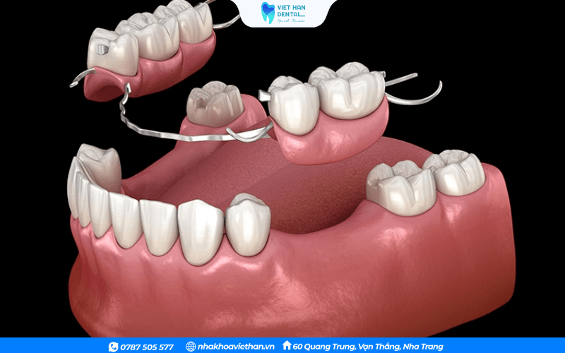 Hàm giả tháo lắp