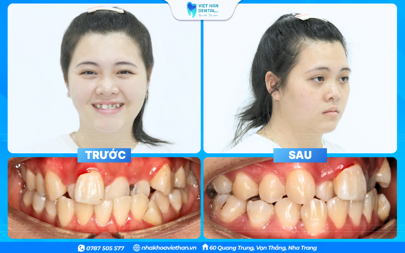 Răng mọc lệch làm cản trở quá trình vệ sinh, dễ tích tụ mảng bám và vi khuẩn, dẫn đến sâu răng
