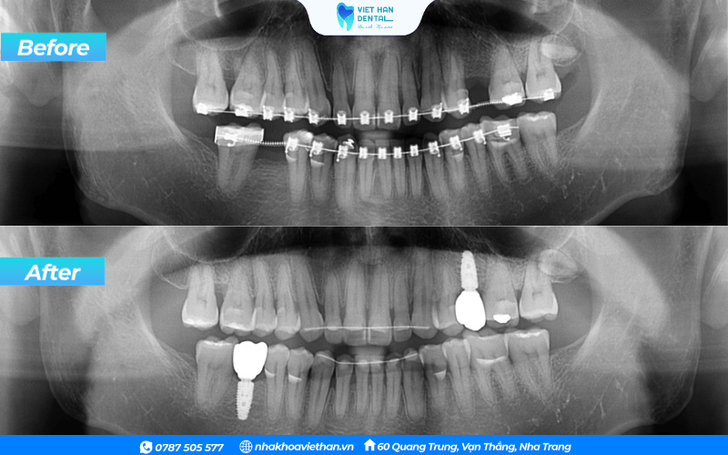 Khách hàng chỉnh nha tiền phục hình răng Implant tại Nha khoa Việt Hàn
