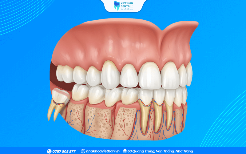 Mô phỏng vị trí của một chiếc răng khôn