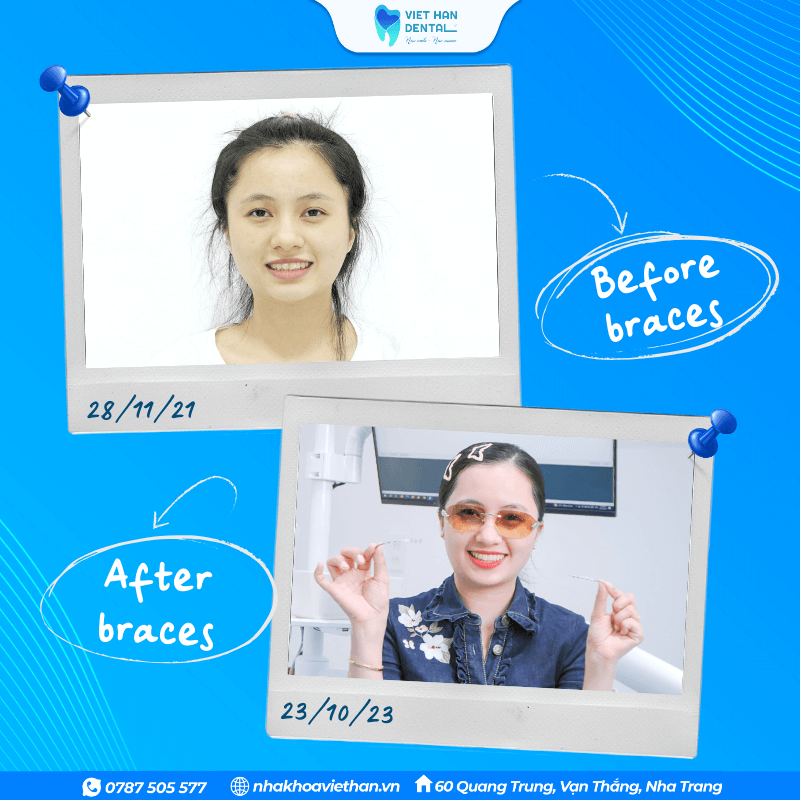 Ms. Oanh before and after wearing braces.