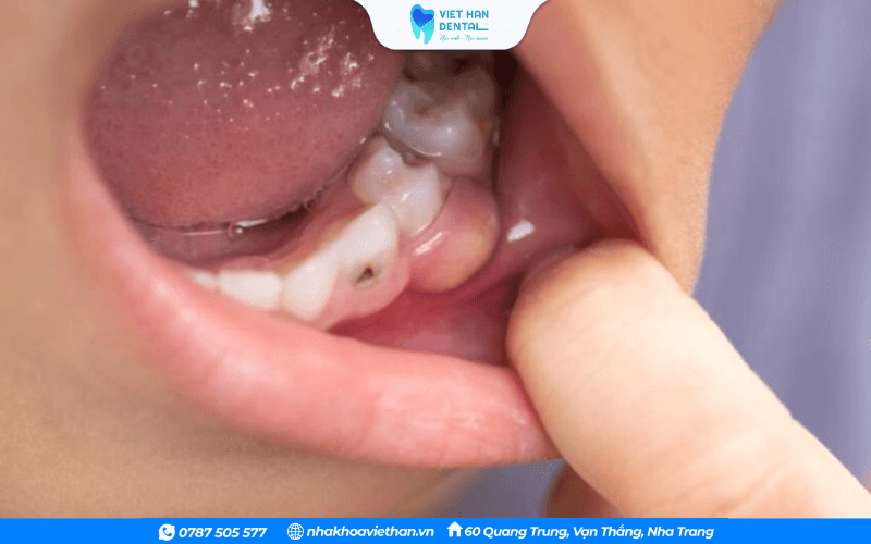 Trẻ bị áp xe răng