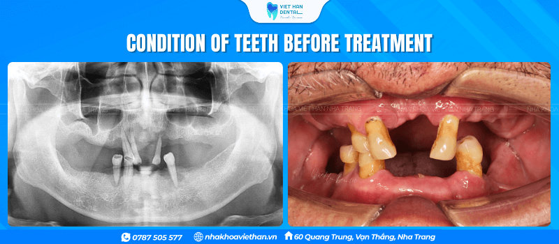 The condition of Mr. Vo Duc Su's teeth before treatment at Viet Han Dental Clinic.
