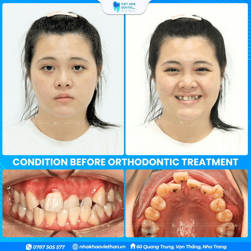 Customer Thuy My before getting braces.