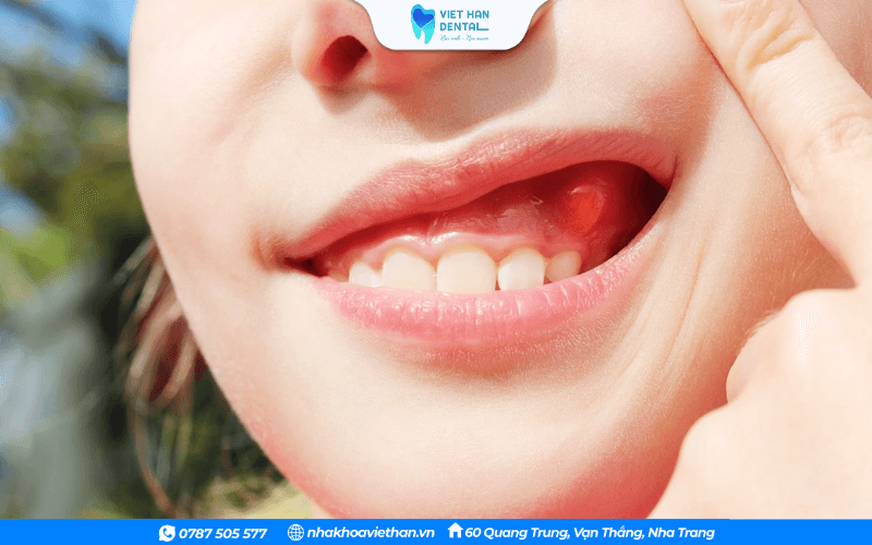 Vùng nướu quanh răng áp xe sưng tấy, có thể đổi màu bất thường