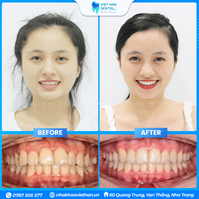 Ms. Oanh before and after orthodontic treatment.