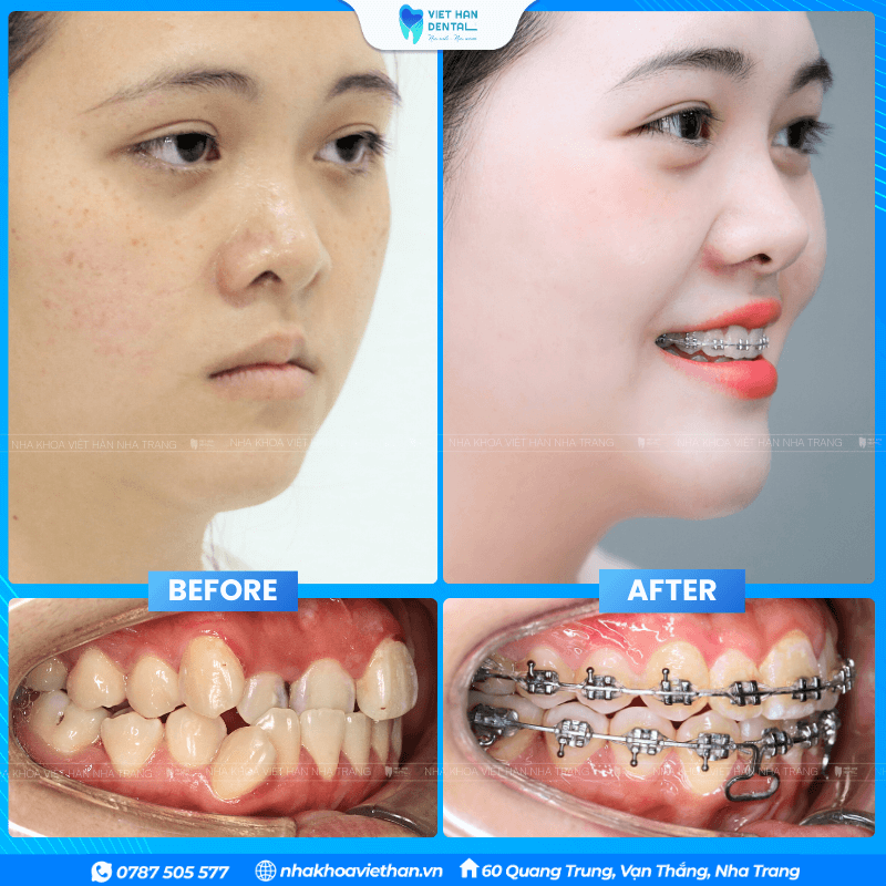 Customer Thuy My before and during orthodontic treatment.