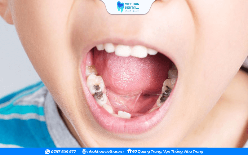 Sâu răng dễ khiến vi khuẩn xâm nhập gây viêm, hình thành áp xe răng