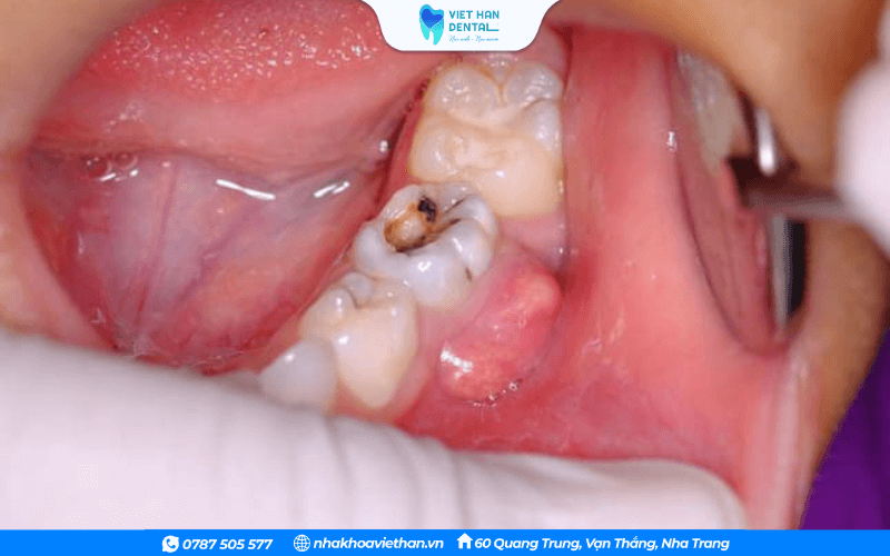 Trẻ bị áp xe răng ở vùng răng bị sâu