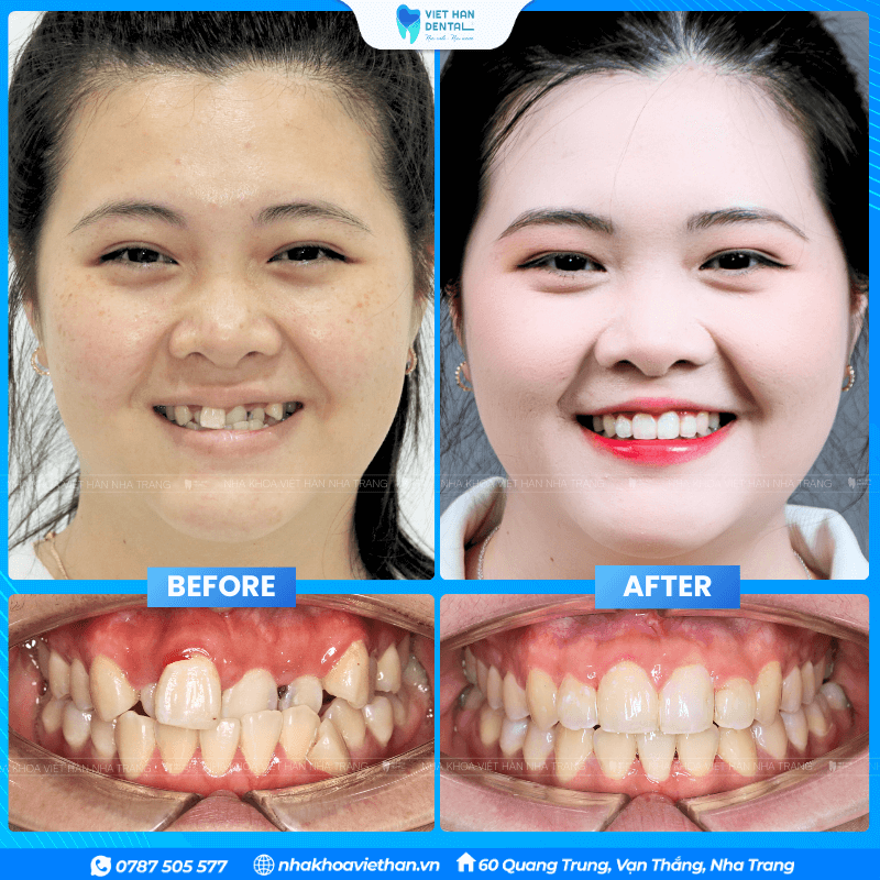 Customer Thuy My before and after orthodontic treatment.