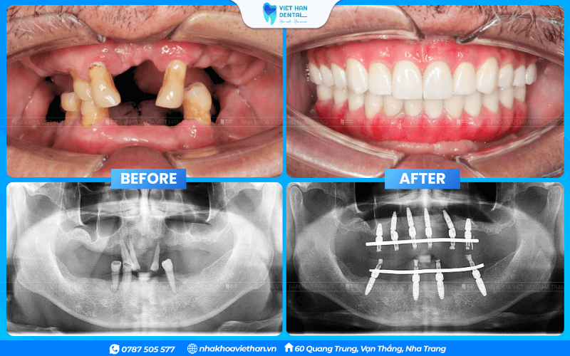 Before and after photos of Mr. Vo Duc Su's teeth after dental implant surgery at Viet Han Dental Clinic.