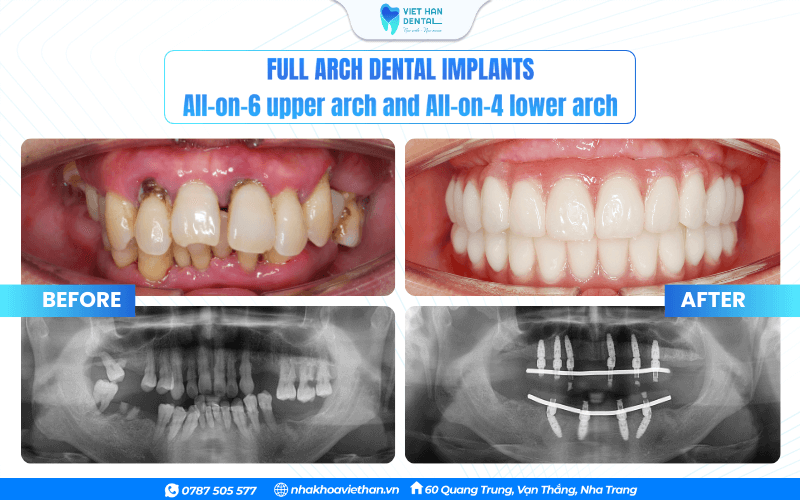 The condition of the teeth after the treatment is completed.