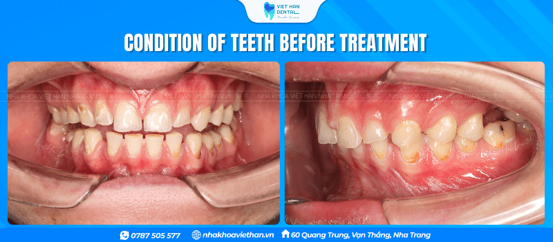 Condition of teeth before treatment