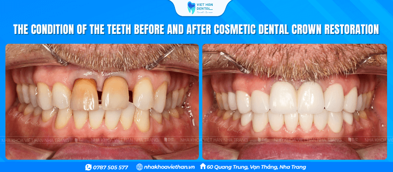 The condition of the teeth before and after cosmetic porcelain dental restoration at Viet Han Dental Clinic.