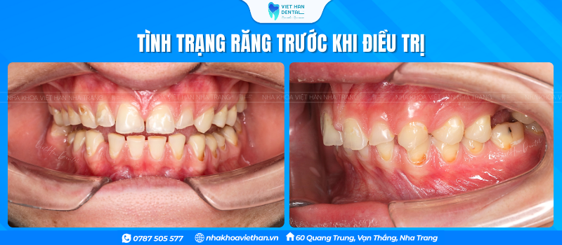Pham Vu Tình Trạng Răng Trước Khi
