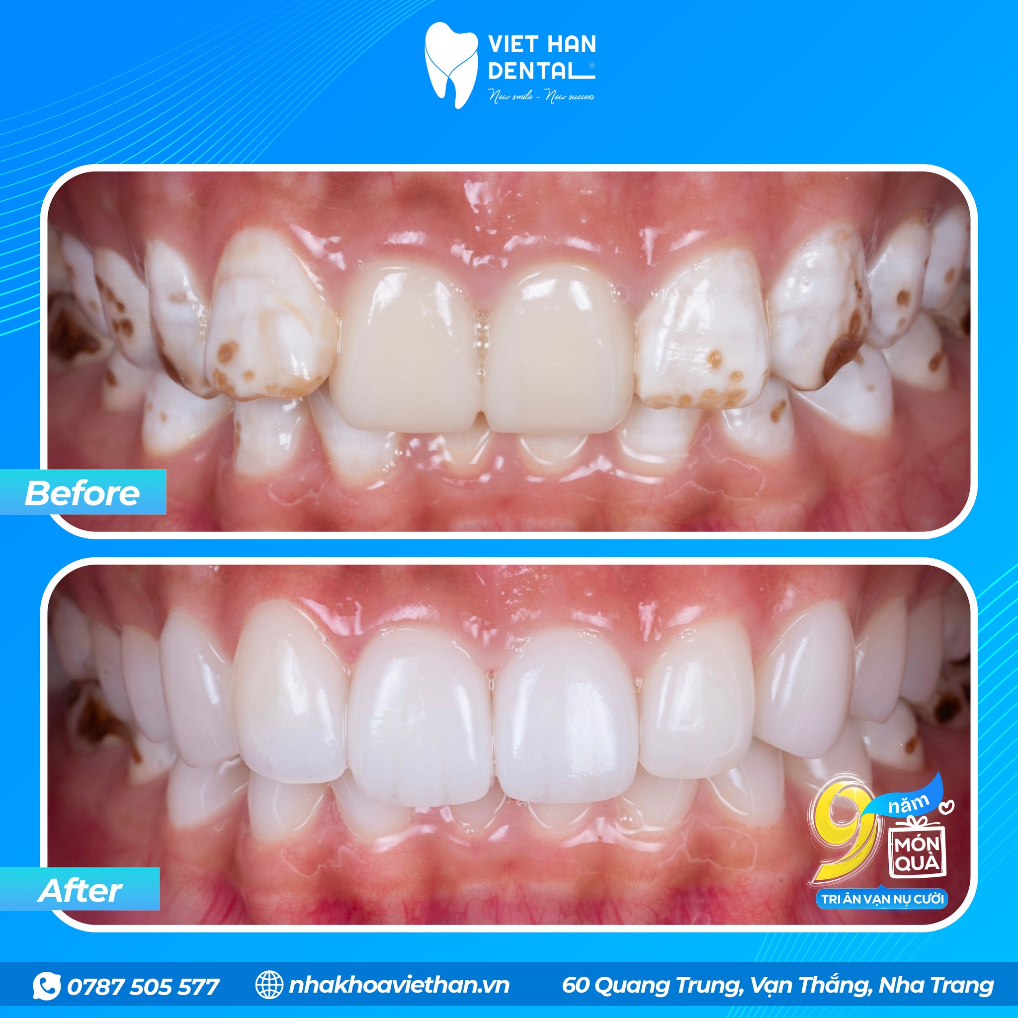 Răng Trước Sau Mỹ Anh