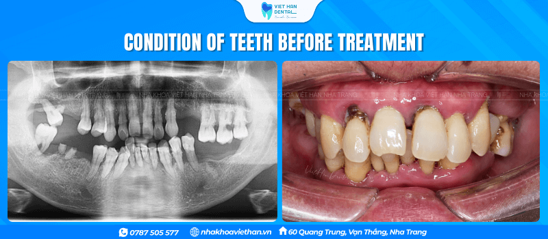 Severe periodontal disease, bone loss in the area of ​​tooth loss.
