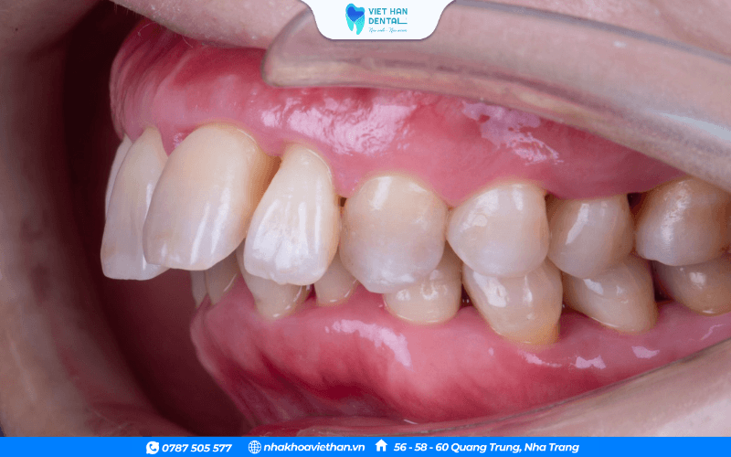 Tình trạng 4 răng cửa bị hô