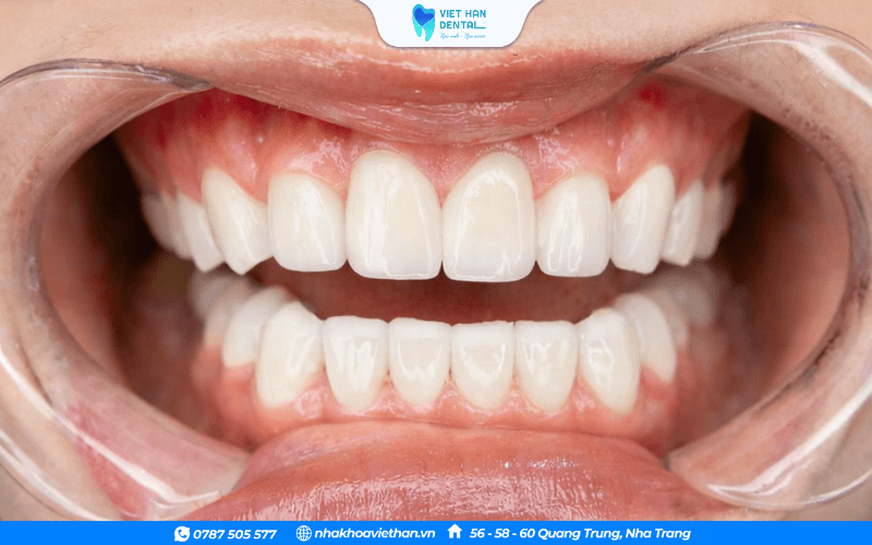 Bọc răng sứ cho 4 răng cửa bị hô giúp cải thiện thẩm mỹ rõ rêtj