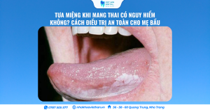 Tưa Miệng Khi Mang Thai